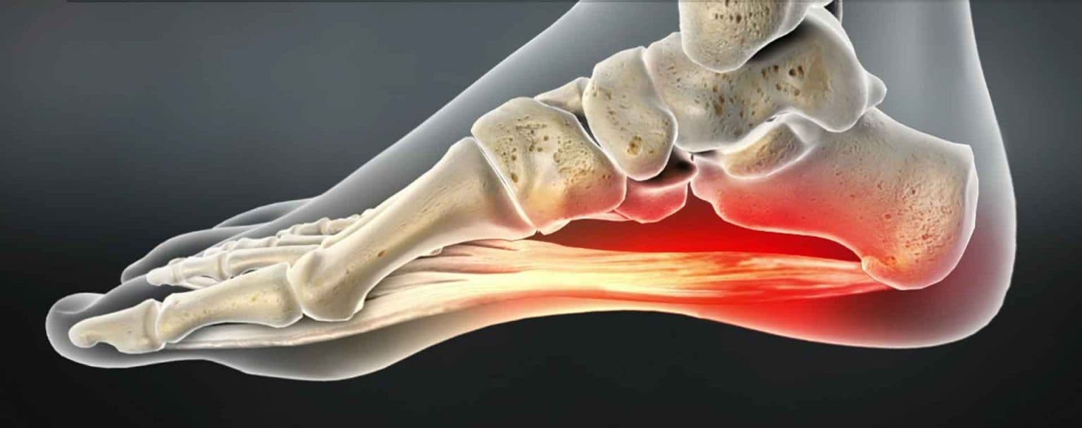 Plantar Fascitis: Causes, Symptoms & Best Treatments