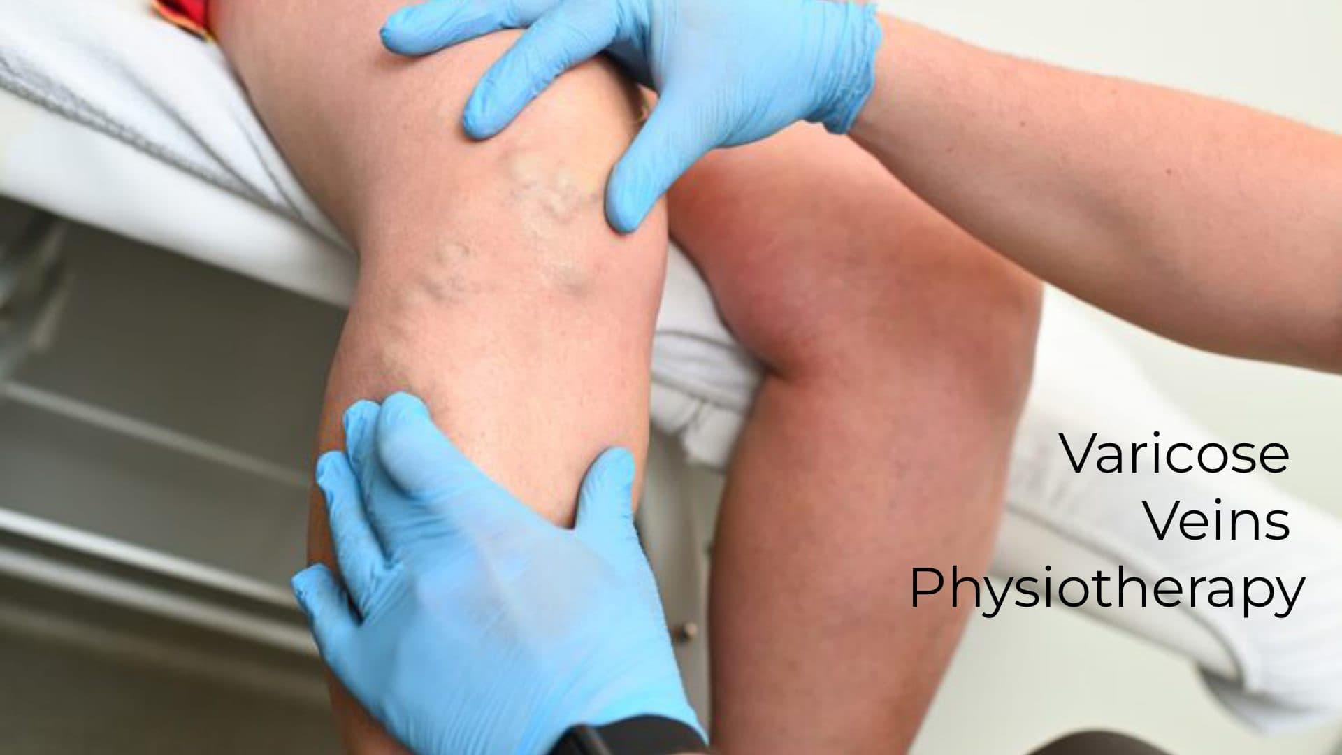 Varicose Veins Physiotherapy: Treatment, Exercises & Recovery Guide